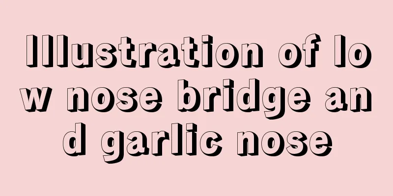 Illustration of low nose bridge and garlic nose