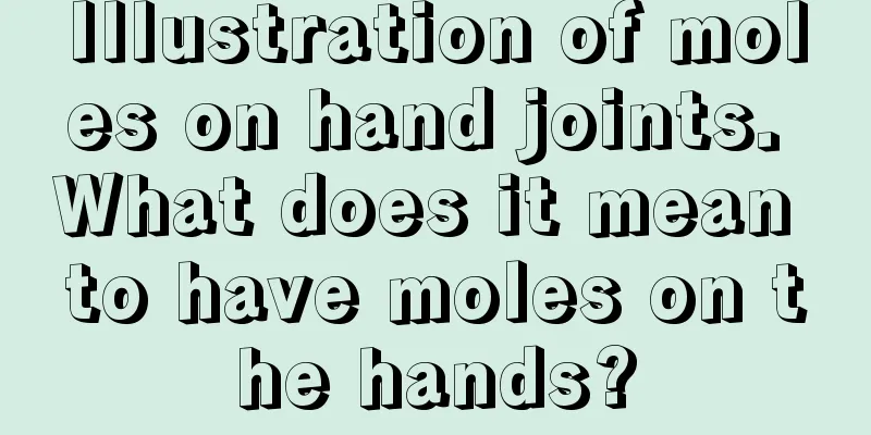Illustration of moles on hand joints. What does it mean to have moles on the hands?