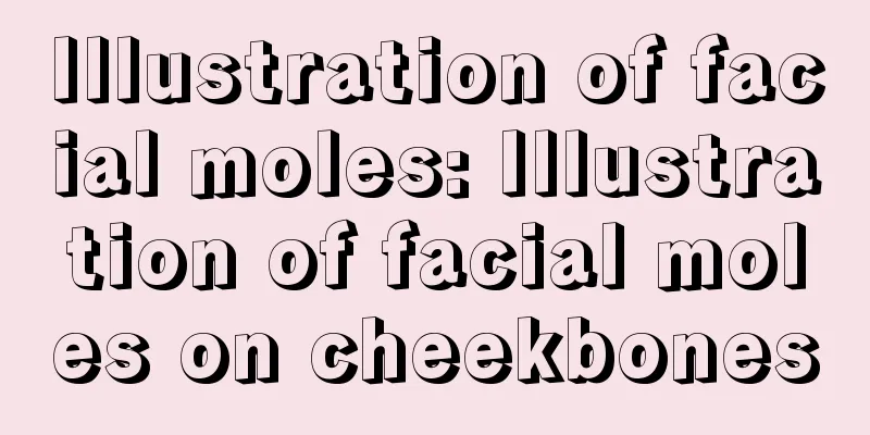 Illustration of facial moles: Illustration of facial moles on cheekbones