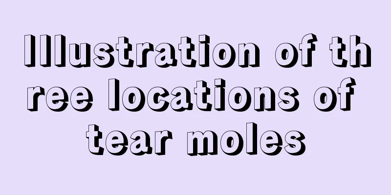 Illustration of three locations of tear moles