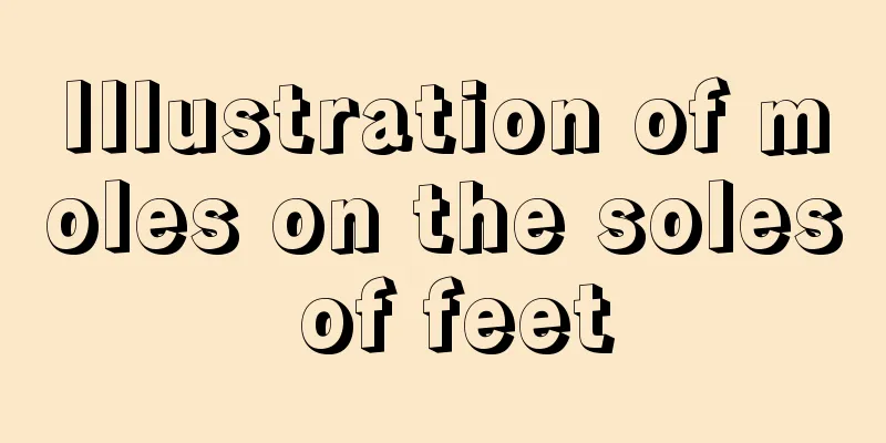Illustration of moles on the soles of feet