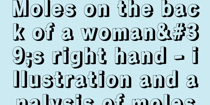 Moles on the back of a woman's right hand - illustration and analysis of moles