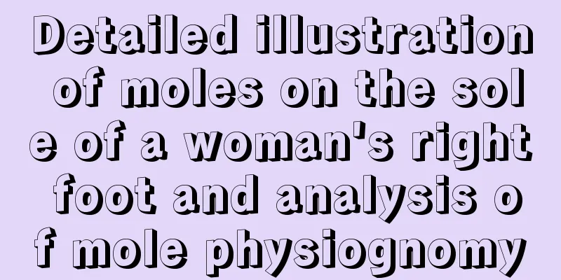 Detailed illustration of moles on the sole of a woman's right foot and analysis of mole physiognomy