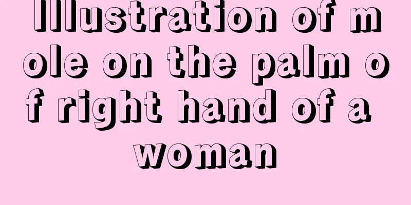 Illustration of mole on the palm of right hand of a woman